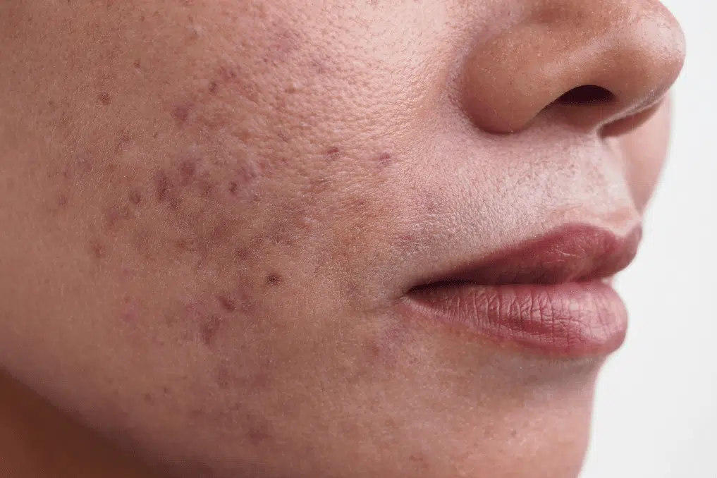 natural cure for hyperpigmentation